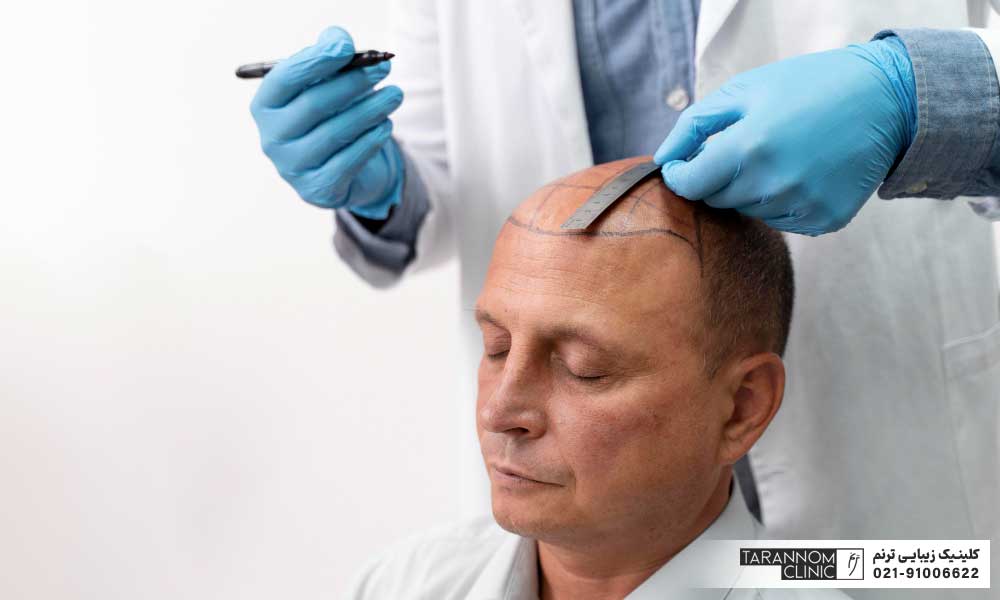 تصویر پزشک در حال علامت گذاری بر روی سر مراجعه کننده مرد - کاشت مو