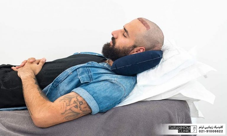 تصویر مردی که بعد از کاشت مو خوابیده است - طرز خوابیدن پس از کاشت مو