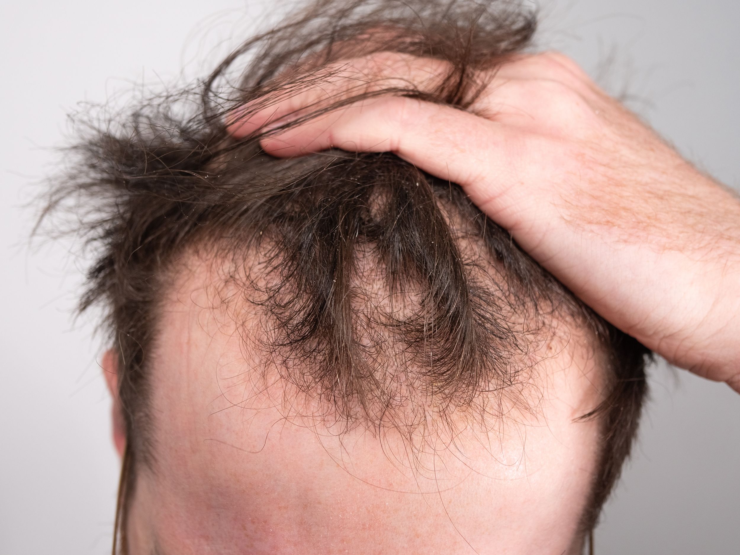 درمان ریزش مو با سدر