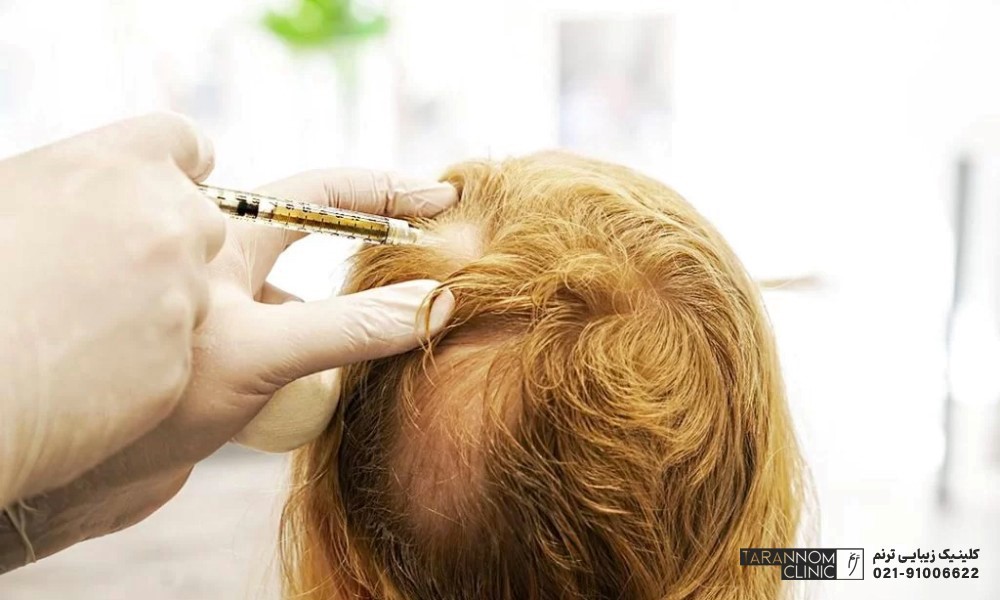 درمان ریزش مو هورمونی در زنان