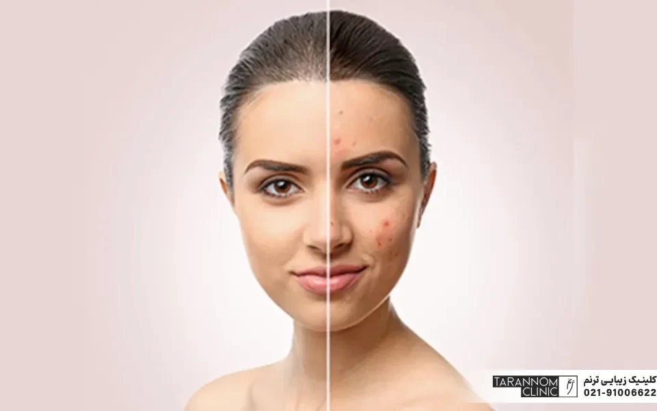 تصویر قبل و بعد رفع لک صورت - درمان تخصصی لک صورت