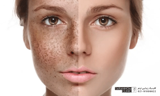مقایسه پوست قبل و بعد از لیزر کک و مک صورت