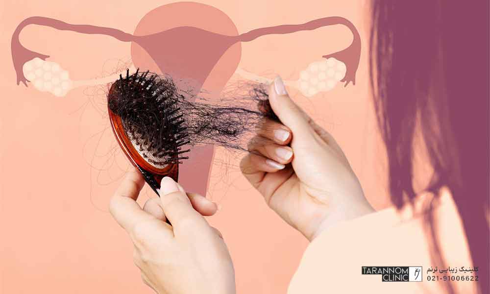 درمان ریزش موی ناشی از کیست تخمدان