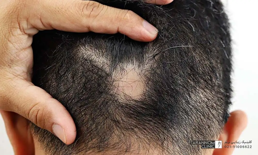 روش‌های درمان مو چیست؟
