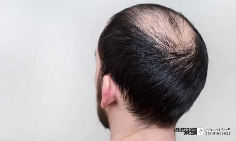 تصویر مرد جوان از پشت سر که دچار تاسی شده است - تفاوت ریزش موهای ارثی و هورمونی