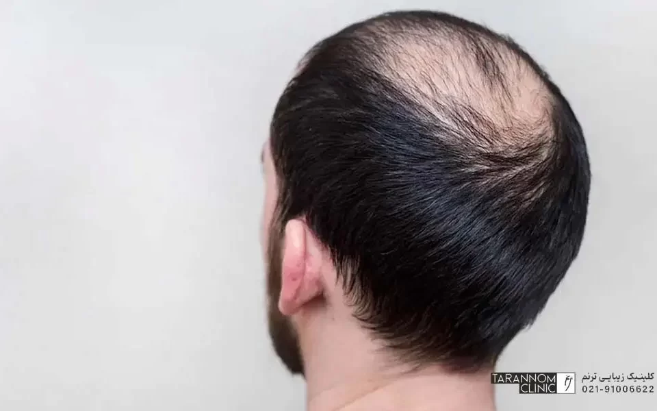تصویر مرد جوان از پشت سر که دچار تاسی شده است - تفاوت ریزش موهای ارثی و هورمونی