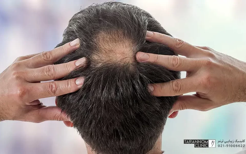 تصویر مرد که بخاطر کبد چرب دچار ریزش مو شده است - آیا کبد چرب باعث ریزش مو میشود؟