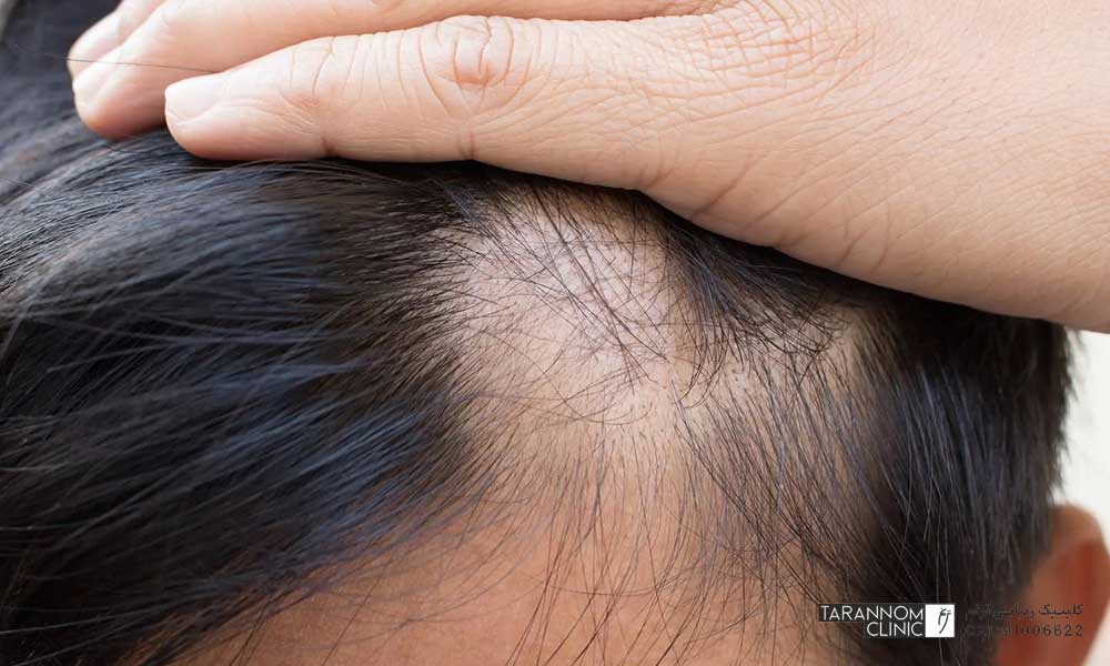  گزینه های درمانی ریزش موی ارثی