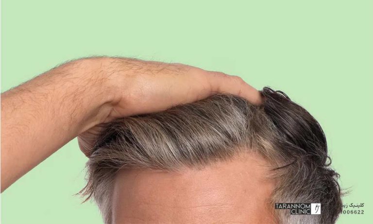 ریزش مو در چه سنی طبیعی است؟