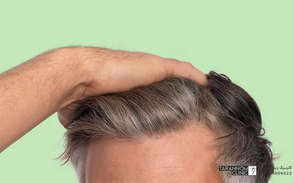 ریزش مو در چه سنی طبیعی است؟