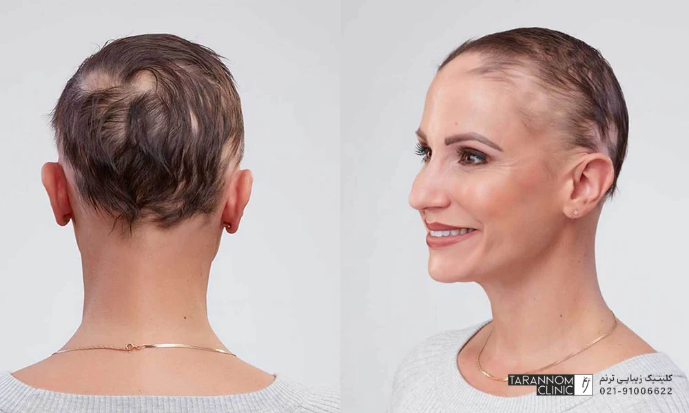 درمان ریزش مو سکه ای در زنان به صورت کچلی در نواحی کوجک سر ظاهر می شود