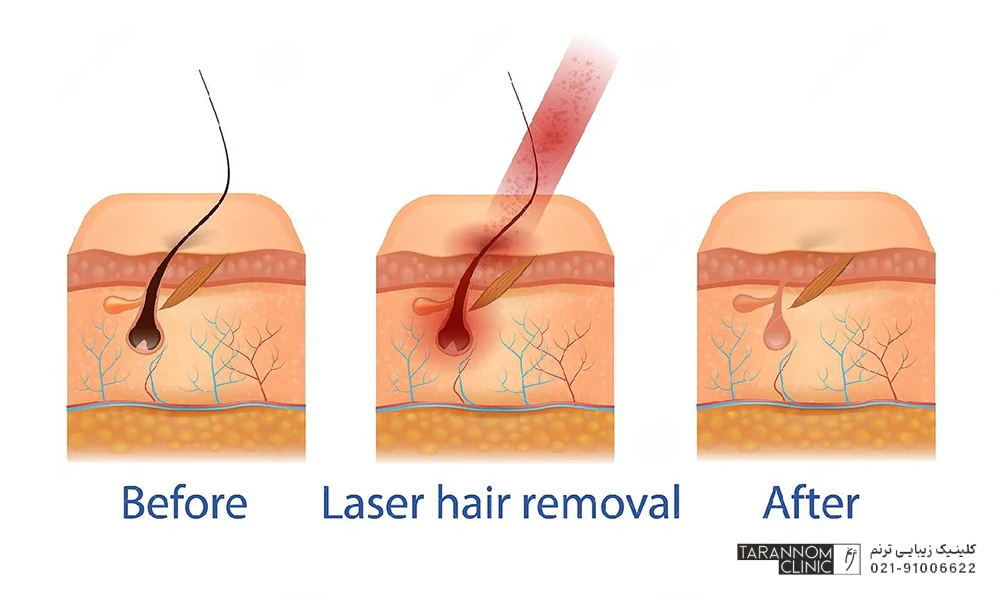 اشعه لیزر یک پرتو نور بسیار قوی است که به فولیکول مو آسیب می زند اما برای پوست ضرر ندارد