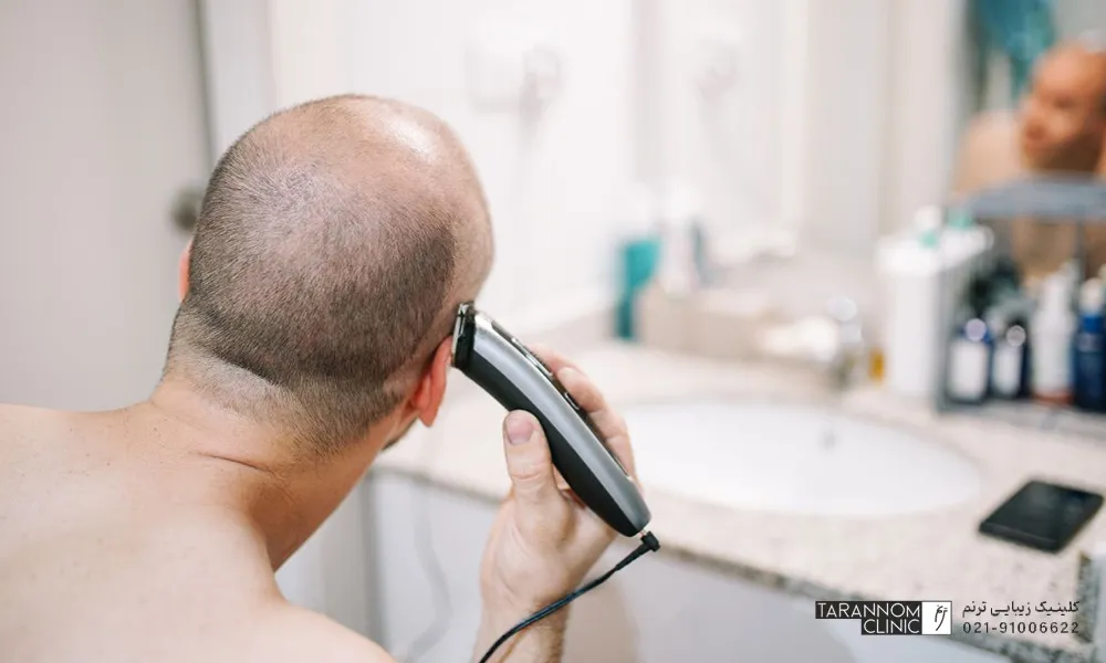 تراشیدن موها قبل از کاشت مو چه مزایایی دارد ؟