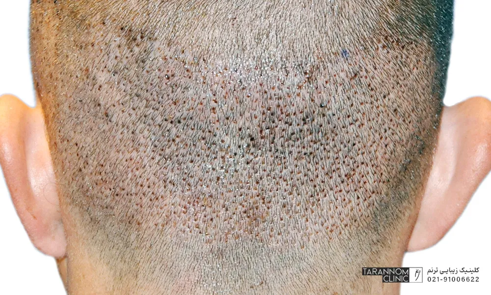 زخم های بعد از کاشت مو چه می شوند ؟