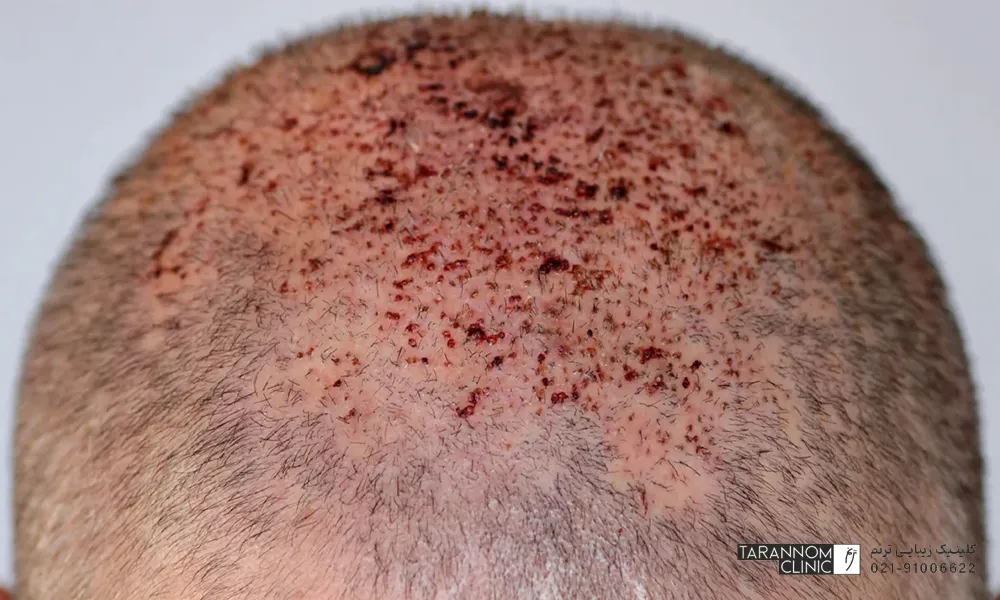 کاشت مو چه خطراتی می تواند داشته باشد ؟