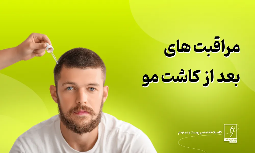 مراقبت های بعد از کاشت مو: مهم ترین نکات