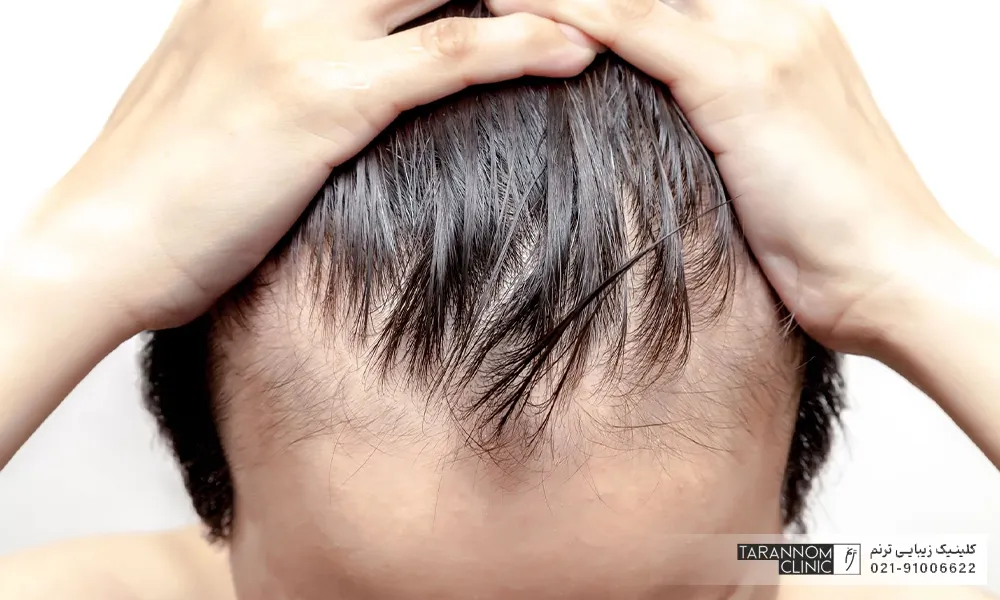 ریزش مو در مردان2