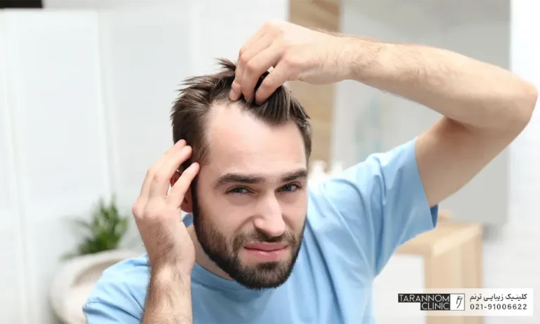 مهمترین علل ریزش موی مردان