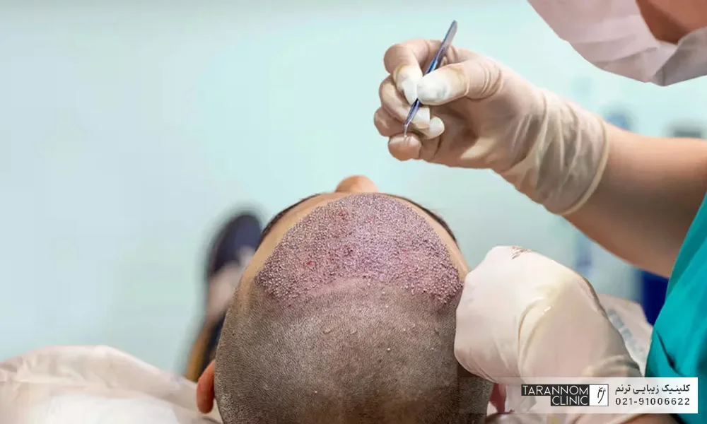 پزشک در حال پیوند گرافت مو به ناحیه جلوی سر مرد جوان - سن مناسب برای کاشت مو
