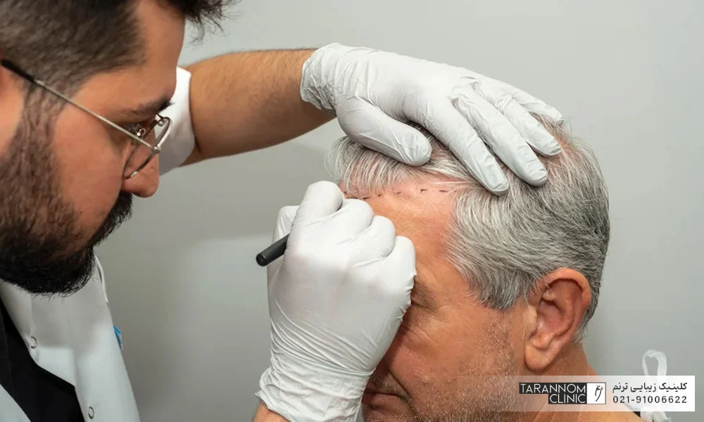 متخصص کاشت مو در حال ترسیم خط رویش روی پیشانی مرد مسن