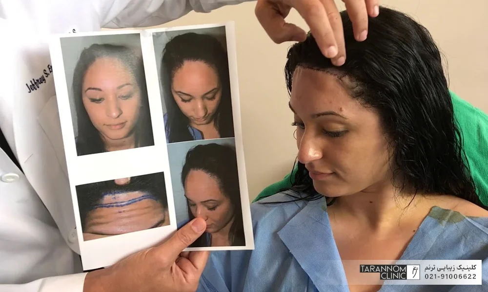 پزشک در حال نشان دادن خط رویش روی پیشانی زن جوان و نشان دادن عکس های قبل از درمان - سن مناسب برای کاشت مو