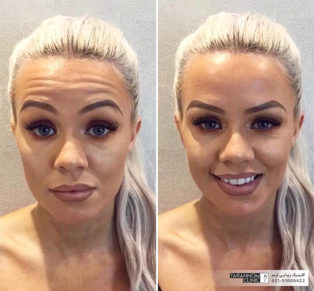عکس قبل و بعد تزریق بوتاکس پیشانی به زن جوان با موهای بلوند