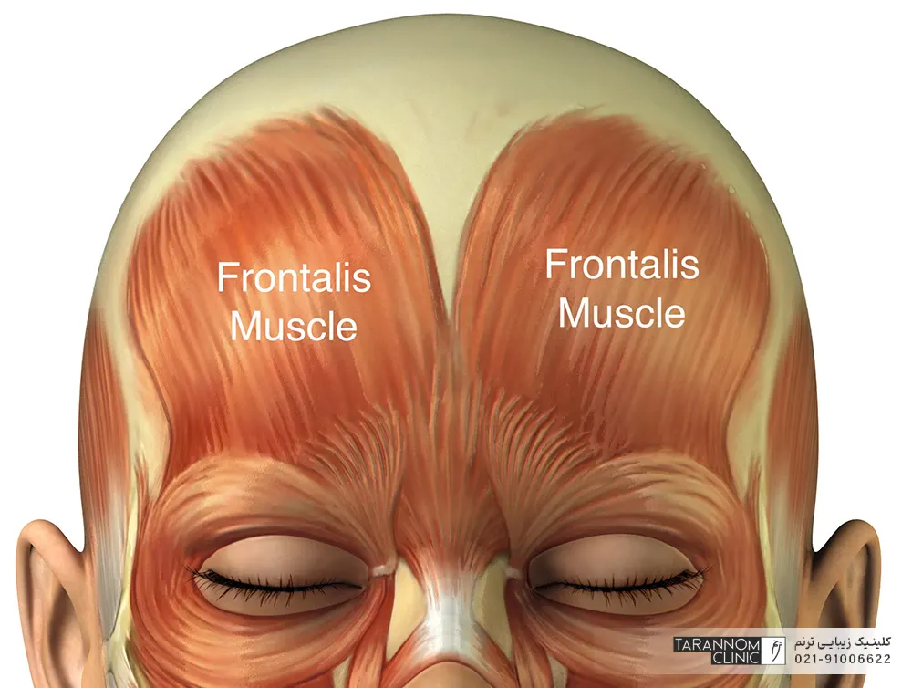 عضلات فرانتالیس در پیشانی - تزریق بوتاکس پیشانی