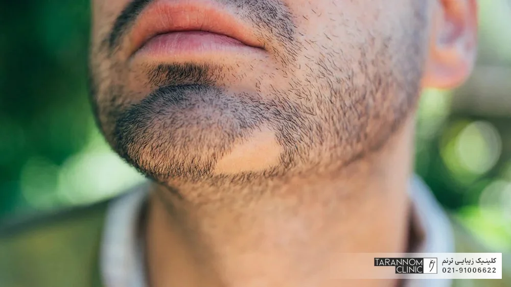 ریزش ریش در اثر آلوپسی - کاشت ریش و سبیل