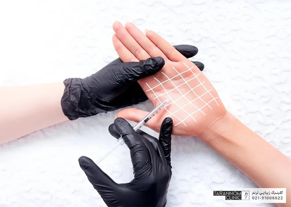 عکس پزشک زیبایی که دستکش مشکلی به دست دارد و به کف دست مراجعه کننده بوتاکس تزریق می کند