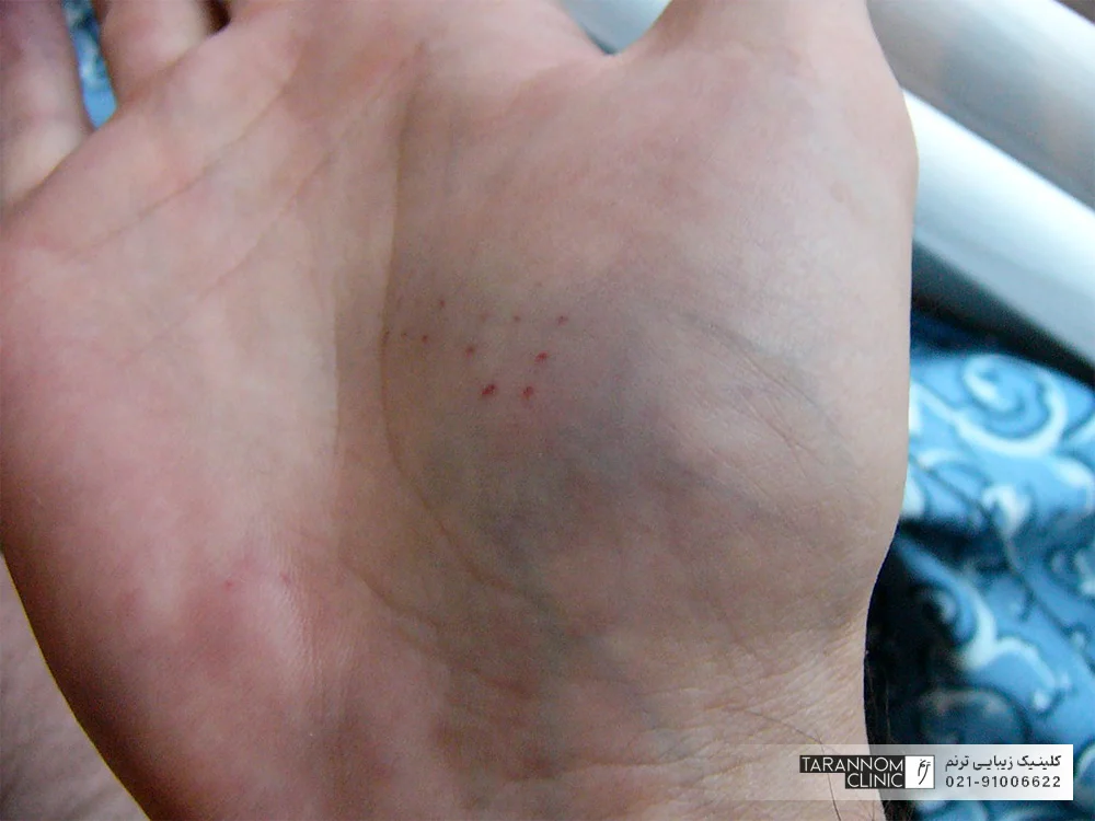 عکس کبودی و قرمزی کف دست بعد از تزریق بوتاکس