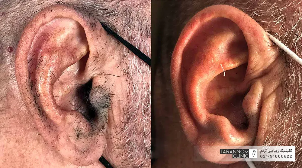 عکس قبل و بعد لیزر موهای زائد گوش
