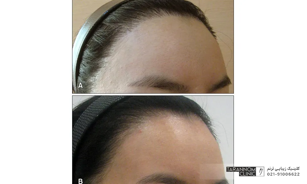 قبل و بعد فردی که موهای پیشانی اش را لیزر کرده است