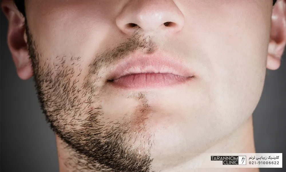 عکس قبل و بعد لیزر صورت یک آقا
