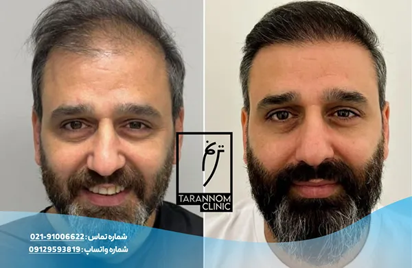 نمونه نتایج کاشت مو در کلینیک ترنم