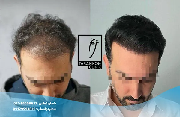 نمونه نتایج کاشت مو در کلینیک ترنم
