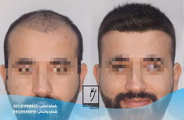 نمونه نتایج کاشت مو در کلینیک ترنم