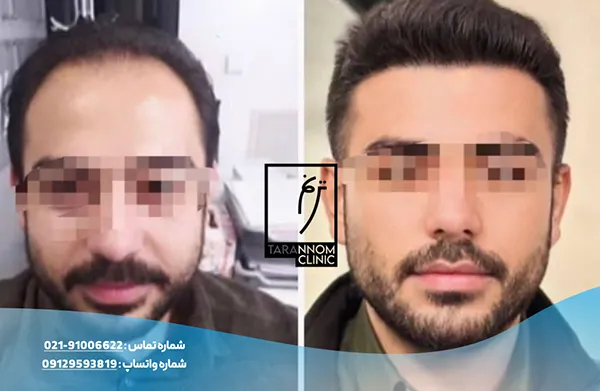 نمونه نتایج کاشت مو در کلینیک ترنم
