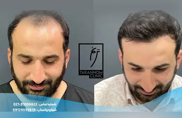 نمونه نتایج کاشت مو در کلینیک ترنم