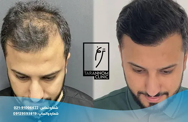 نمونه نتایج کاشت مو در کلینیک ترنم