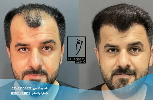 نمونه نتایج کاشت مو در کلینیک ترنم