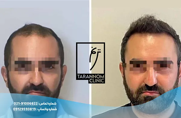 نمونه نتایج کاشت مو در کلینیک ترنم