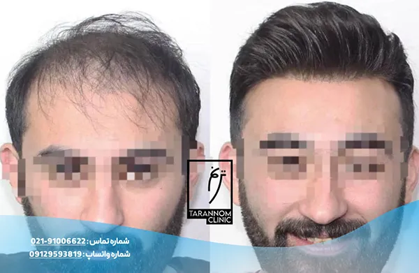 نمونه نتایج کاشت مو در کلینیک ترنم
