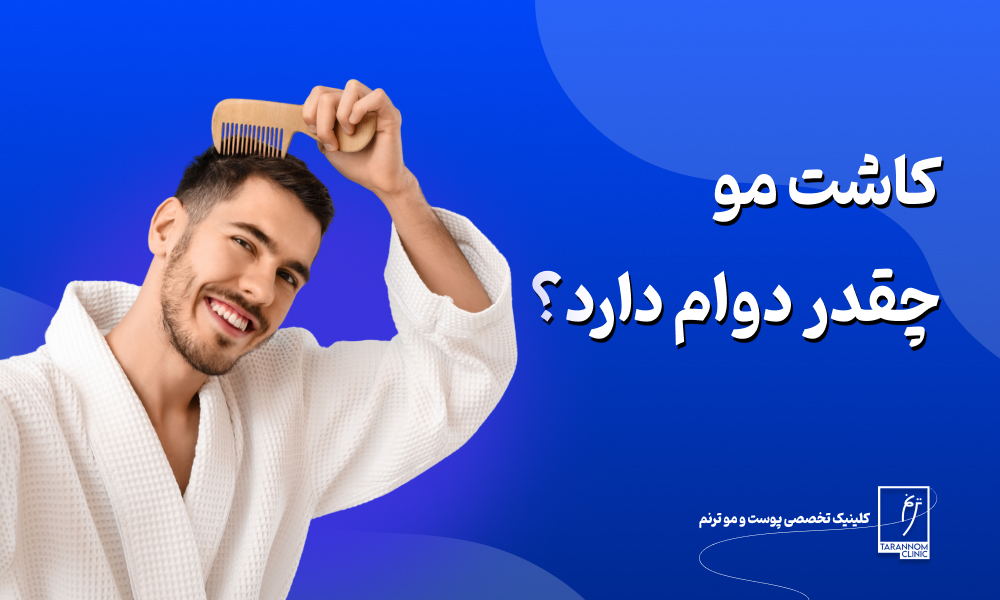 ماندگاری کاشت مو چقدر است؟ دائمی است؟ + عوامل تاثیرگذار