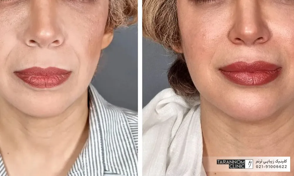 عکس قبل و بعد تزریق فیلر خط خنده به صورت زن