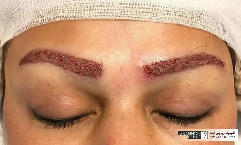 فردی که چشم هایش بسته است و کاشت ابرو انجام داده است