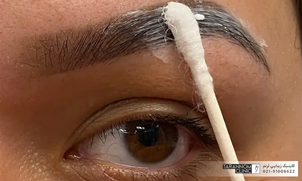 فردیکه با گوش در حال مالیدن پماد به ابروهایش است