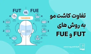 تفاوت کاشت مو به روش های FUE و FUT