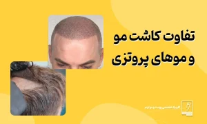 تفاوت موهای پروتزی و کاشت مو
