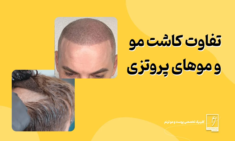 تفاوت موهای پروتزی و کاشت مو