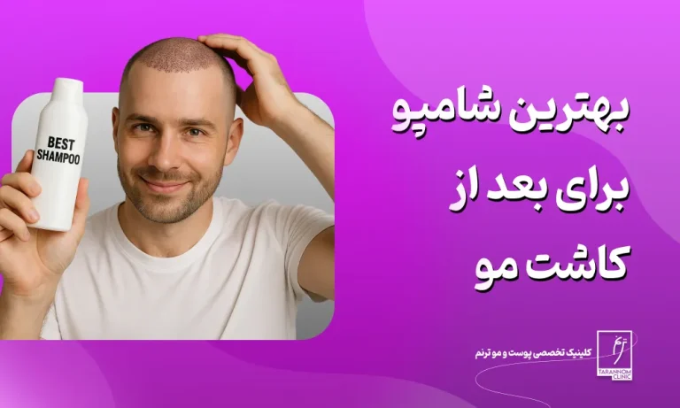 بهترین شامپو برای بعد از کاشت مو